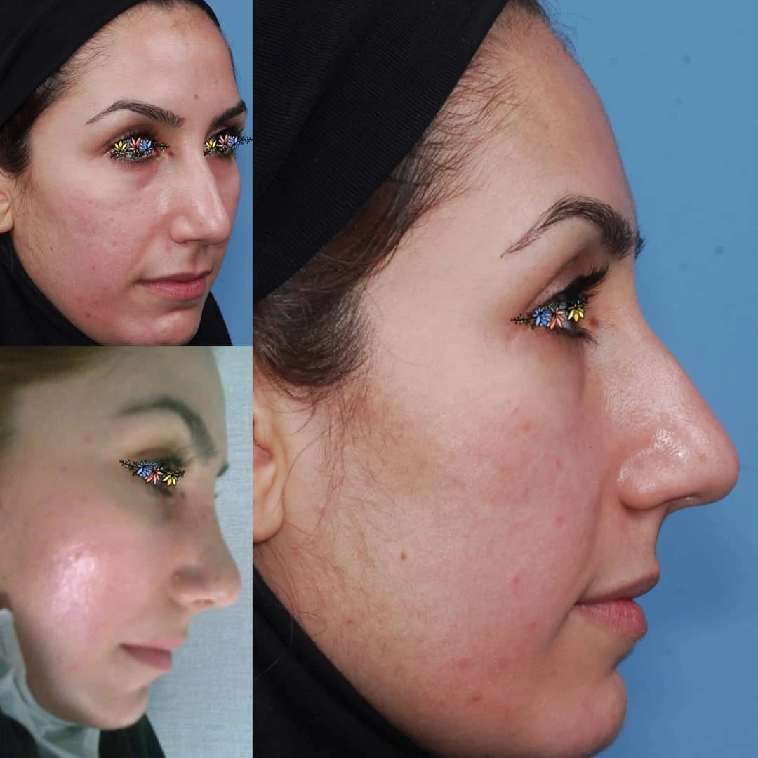 جراحی زیبایی و درمانی بینی - مجموعه D (قسمت 2)
