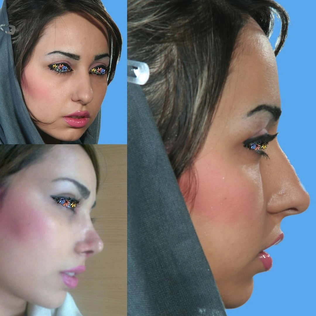جراحی زیبایی و درمانی بینی - مجموعه E (قسمت 1)