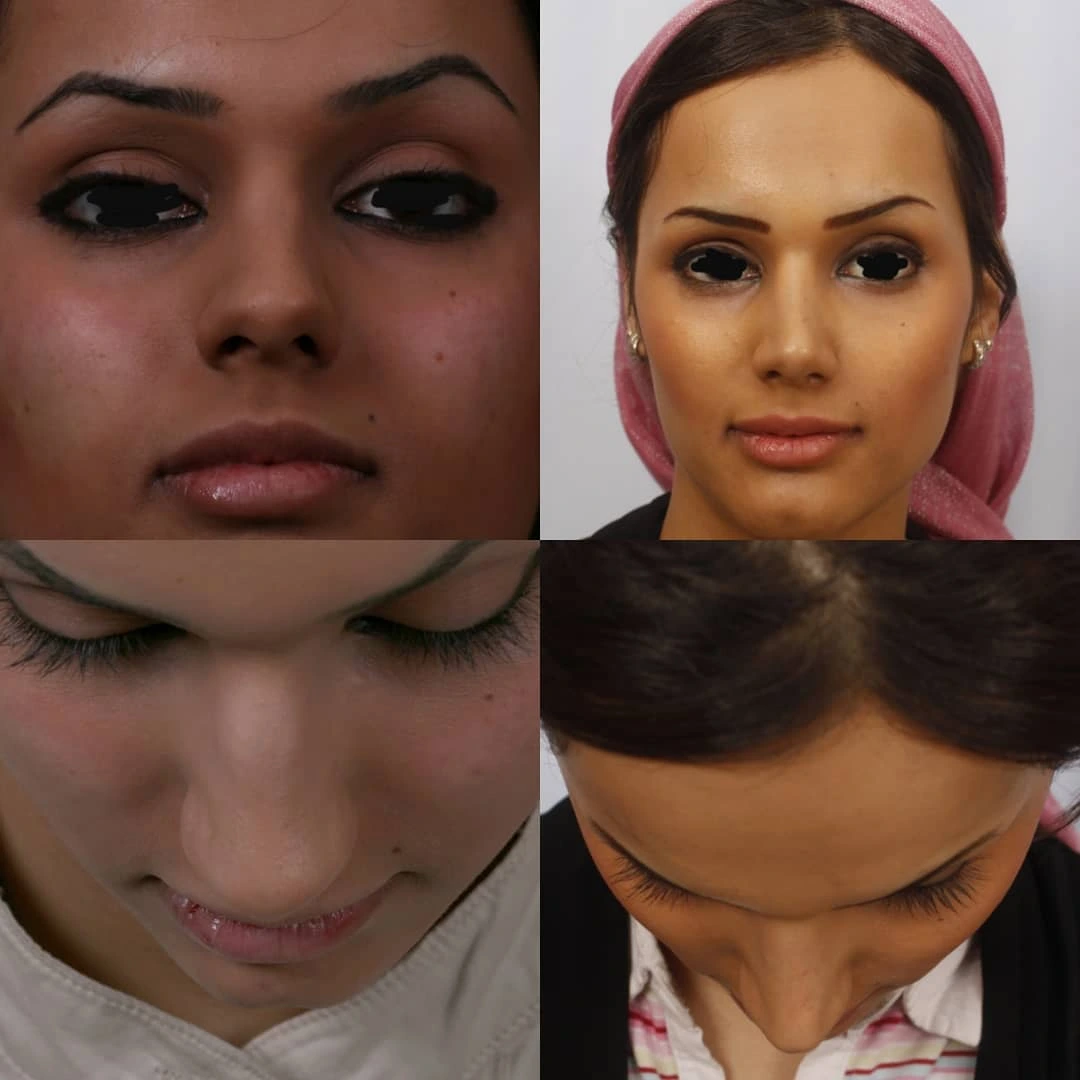 جراحی زیبایی و درمانی بینی - مجموعه I (قسمت 3)
